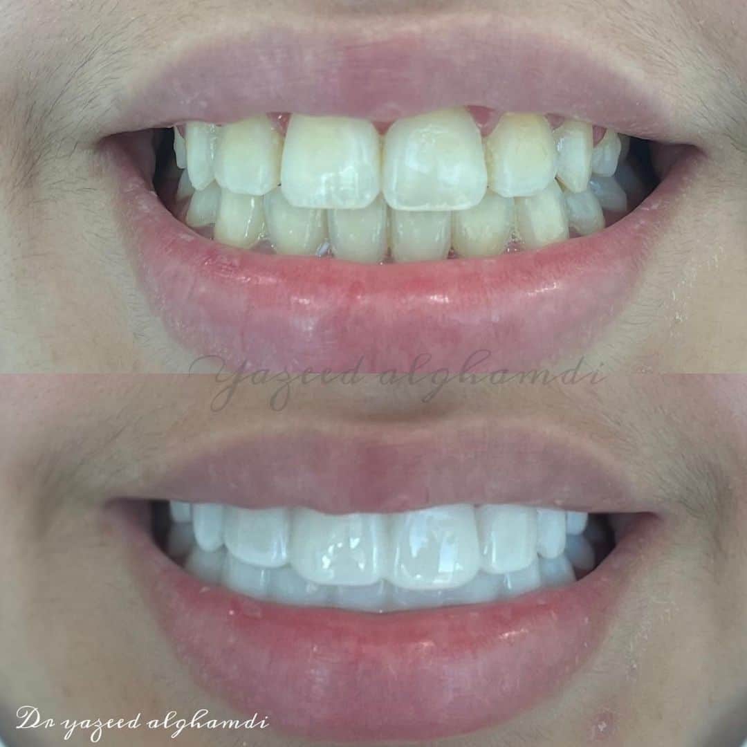 الابتسامة-المتحركة-سناب-اون-سمايل-حل-سريع-للحصول-على-ابتسامة-جميلة-من-دون-برد-للاسنان-وفي-جلستين-فقط-د.-يزيد-الغامدي الابتسامة-المتحركة-سناب-اون-سمايل-حل-سريع-للحصول-على-ابتسامة-جميلة-من-دون-برد-للاسنان-وفي-جلستين-فقط-د.-يزيد-الغامدي