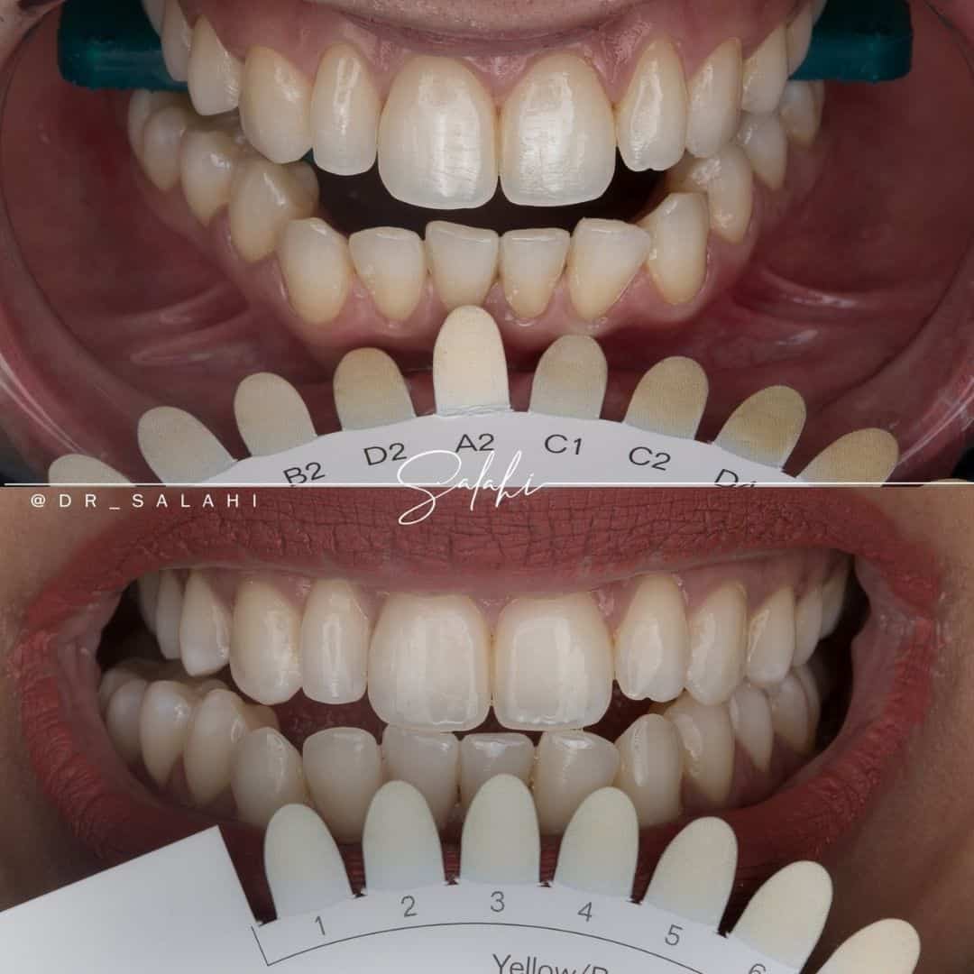 تبييض-الأسنان-في-العيادة-د.-أحمد-الصلاحي تبييض-الأسنان-في-العيادة-د.-أحمد-الصلاحي