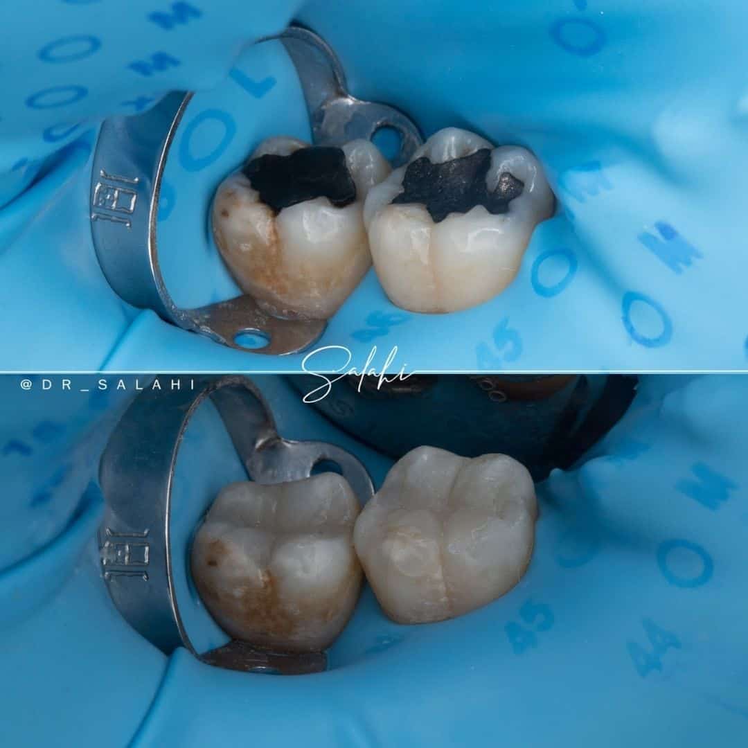 تغيير-حشوات-فضية-بحشوات-تجميلية-باستخدام-العازل-المطاطي-د.-أحمد-الصلاحي تغيير-حشوات-فضية-بحشوات-تجميلية-باستخدام-العازل-المطاطي-د.-أحمد-الصلاحي