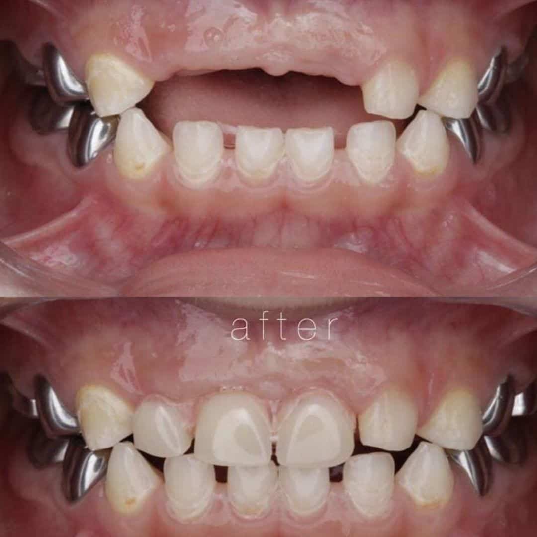 حالة-لطفل-عمره-٣-سنوات-تعرض-لحادثة-سقوط-أدت-إلى-فقدان-الأسنان-الأمامية.-و-تم-تعويض-الأسنان-بتركيبة-مؤقتة-لحين-بروز-الأسنان-الدائمة. حالة-لطفل-عمره-٣-سنوات-تعرض-لحادثة-سقوط-أدت-إلى-فقدان-الأسنان-الأمامية.-و-تم-تعويض-الأسنان-بتركيبة-مؤقتة-لحين-بروز-الأسنان-الدائمة.