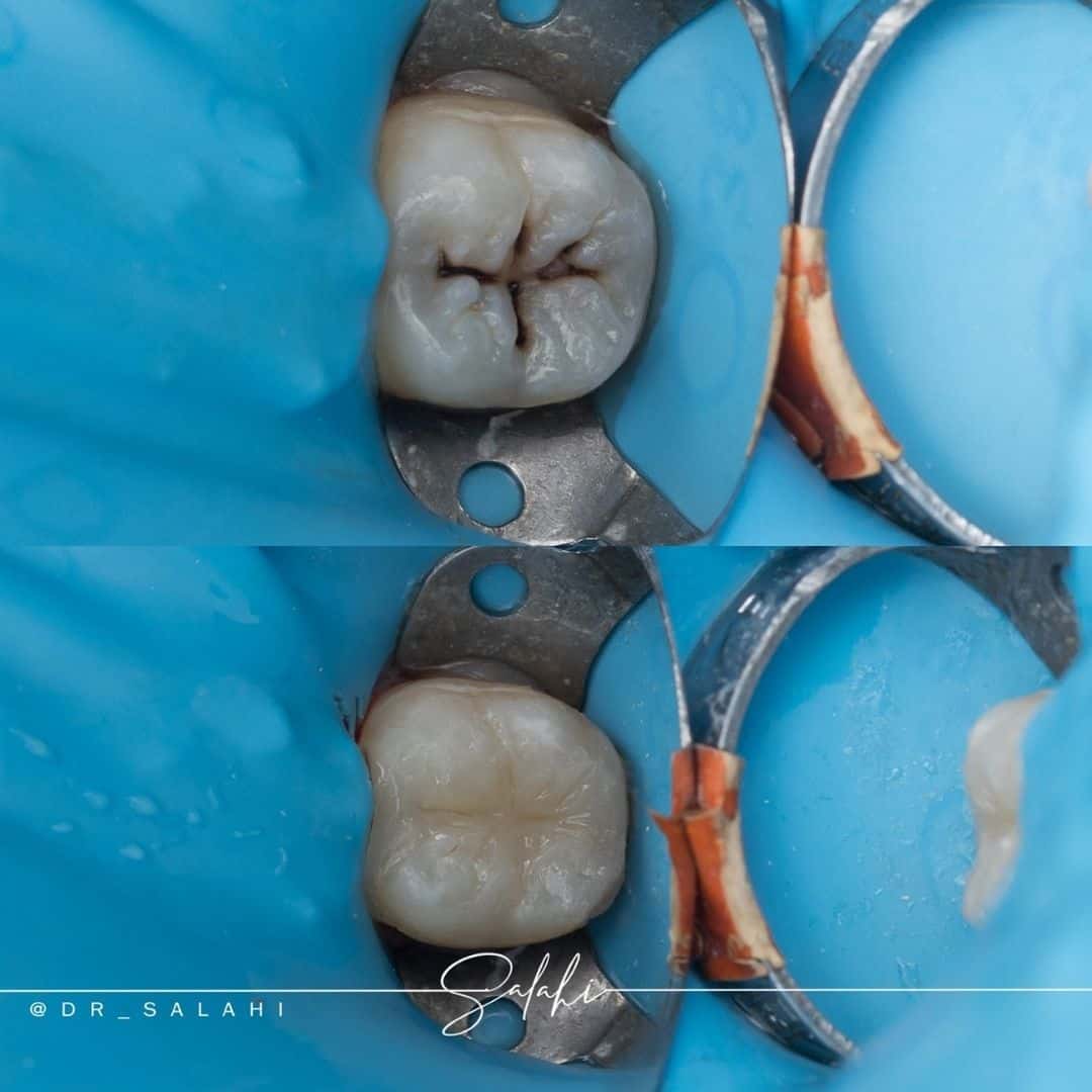 حشوة-تجميلية-باستخدام-العازل-المطاطي-د.-أحمد-الصلاحي حشوة-تجميلية-باستخدام-العازل-المطاطي-د.-أحمد-الصلاحي