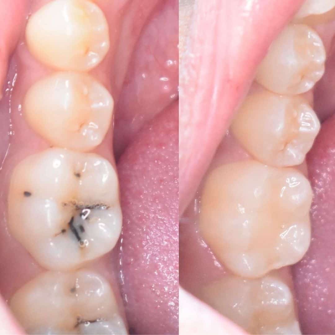 حشوة-تجميلية-لضرس-خلفي-بعد-إزالة-التسوس-د-يزيد-الغامدي حشوة-تجميلية-لضرس-خلفي-بعد-إزالة-التسوس-د-يزيد-الغامدي