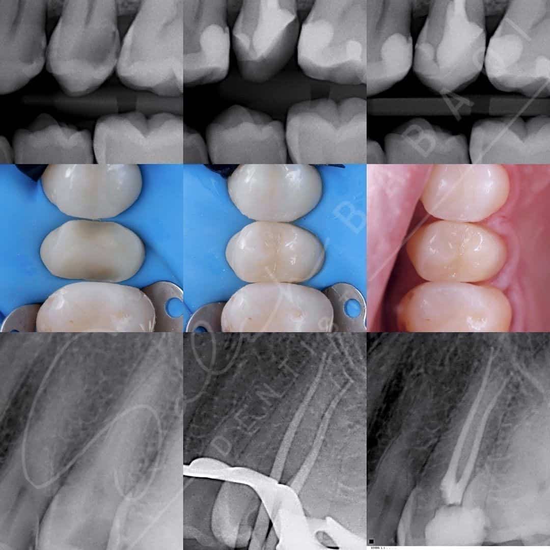 علاج-عصب-ثم-تركيبة-جزئية-من-السيراميك-للضاحك-الثاني-العلوي-في-وجود-الحاجز-المطاطي. علاج-عصب-ثم-تركيبة-جزئية-من-السيراميك-للضاحك-الثاني-العلوي-في-وجود-الحاجز-المطاطي.