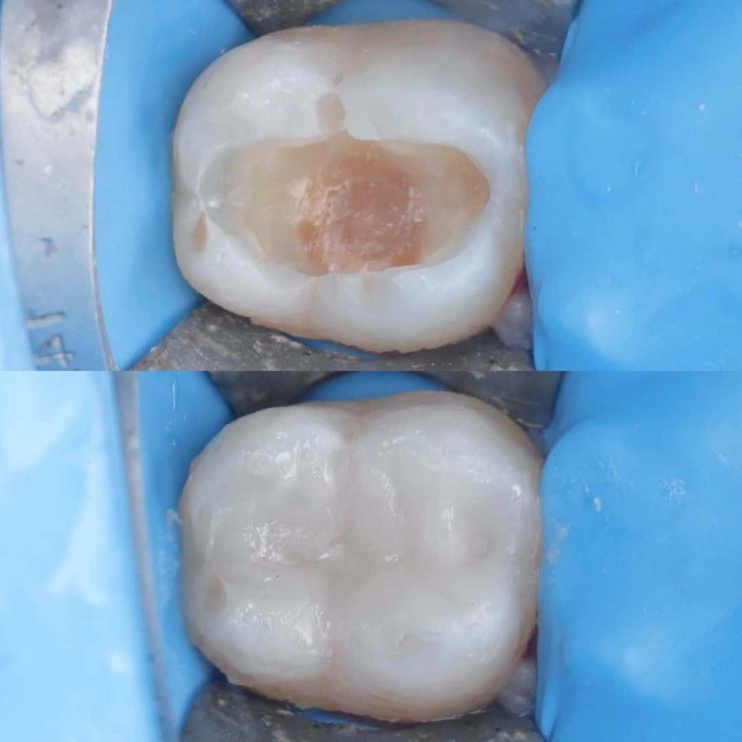 ‎إزالة-التسوس-و-عمل-حشوة-تجميلية-للضرس-السابع-السفلي-في-وجود-الحاجز-المطاطي-د.-صالح-بابقي